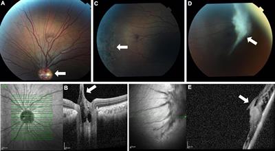A Novel Homozygous Missense Variant in the LRRC32 Gene Is Associated With a New Syndrome of Cleft Palate, Progressive Vitreoretinopathy, Growth Retardation, and Developmental Delay